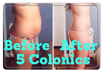 before-and-after-colonic